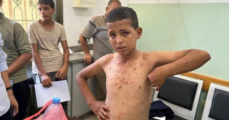 تسجيل 125 ألف إصابة بالأمراض الجلدية في غزة خلال خمسة أشهر