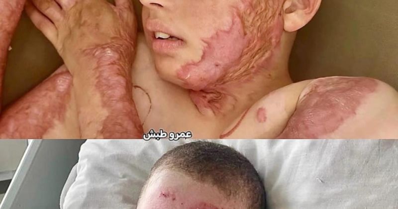 مجد أبو حبيب.. طفلٌ نجا من الحريق، لكن الحرب لاحقته إلى سرير العلاج