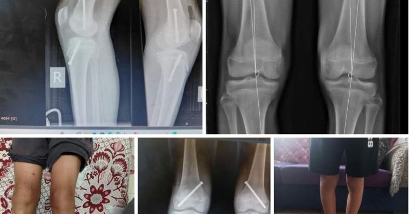 أبو سلمية: أطباء الشفاء يبتكرون تقنية جراحية بجهاز انتُشل من الأنقاض