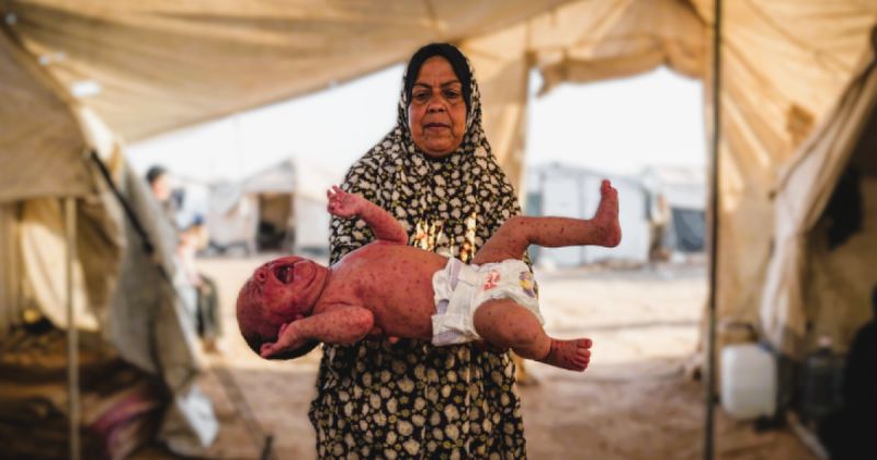 الصحةبغزة: وفاة و10 آلاف إصابة بجدري المياه بين أطفال غزة