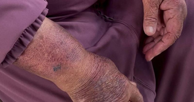 حين خرجت الحاجة منى عياد لقطف التين.. عادت تحمل آثار اعتداء المستوطنين