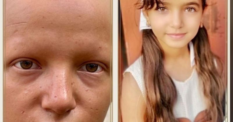 "شو ذنبي إني فقدت شعري؟".. سنا رضوان طفلة من غزة تواجه الحرب بوجع آخر 