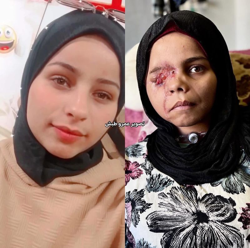 ندى ارحومة .. طفولة سرقت بشظية إسرائيلية وأحلام تنتظر نافذة نجاة