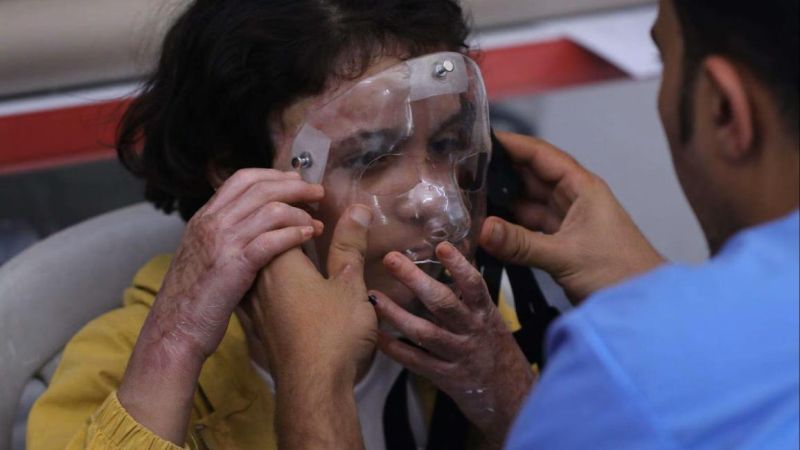 أقنعة ثلاثيا الأبعاد تنقذ أطفال الحروق في غزة.. والحصار يهدد بتوقف العلاج
