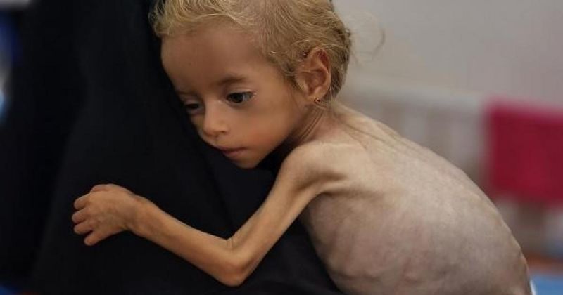 مسؤول طبي : نحو 1.6 مليون شخص مهددون بالمجاعة وسوء التغذية بغزة