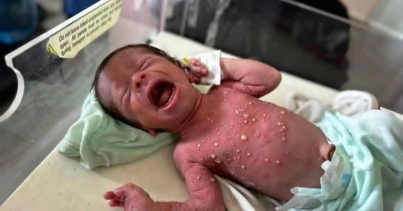 الأمراض الجلدية تنهش أجساد النازحين في غزة تحت حرّ الخيام