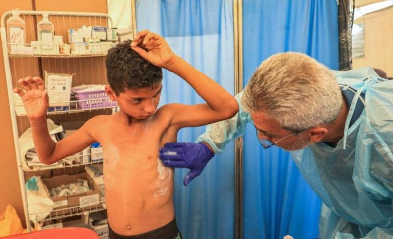 الأمم المتحدة تُحذر من تفشٍ واسع لـ "جدري الماء" يُهدد النازحين في غزة