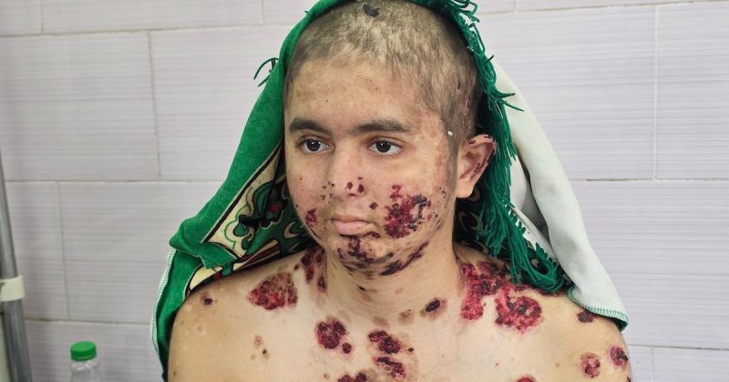 عبد الله الرقب يعاني من مرض جلدي مناعي خطير