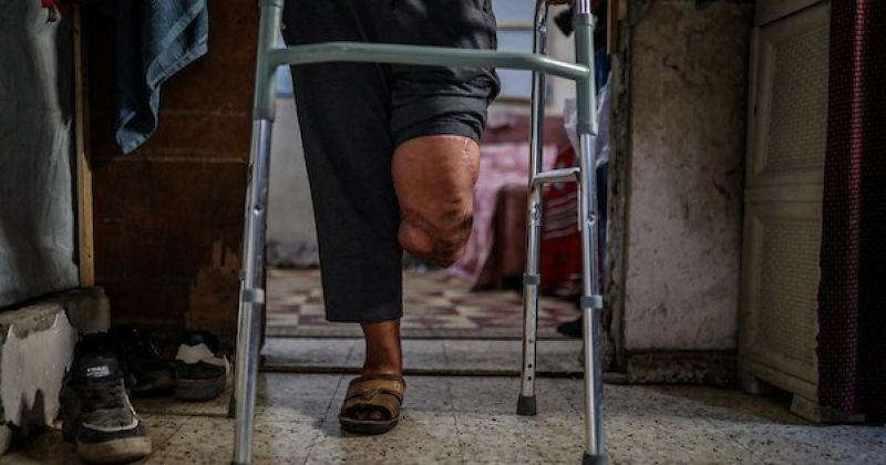 فقد قدمه في قصف إسرائيلي وصودر طرفه الصناعي.. فلسطيني من غزة يواجه معاناة المشي من جديد
