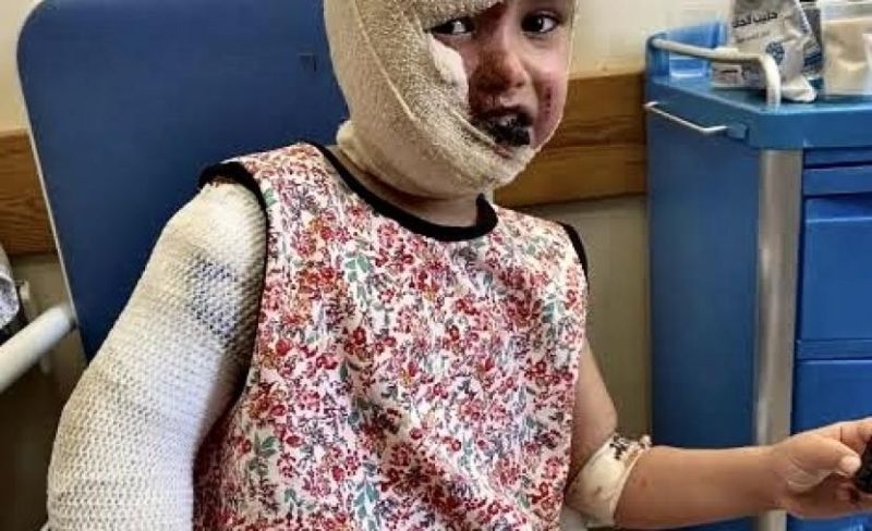 لهيب الحرّ يضاعف وجع القنابل.. مصابو حروق الحرب في غزة بلا علاج