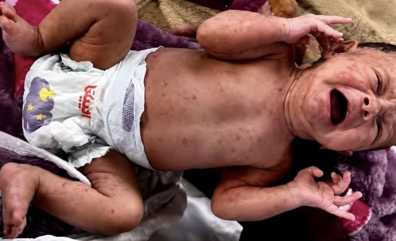 "جدري الماء".. من بثور عابرة إلى سلاح بيولوجي يفتك بـ53 ألف جسد بغزة
