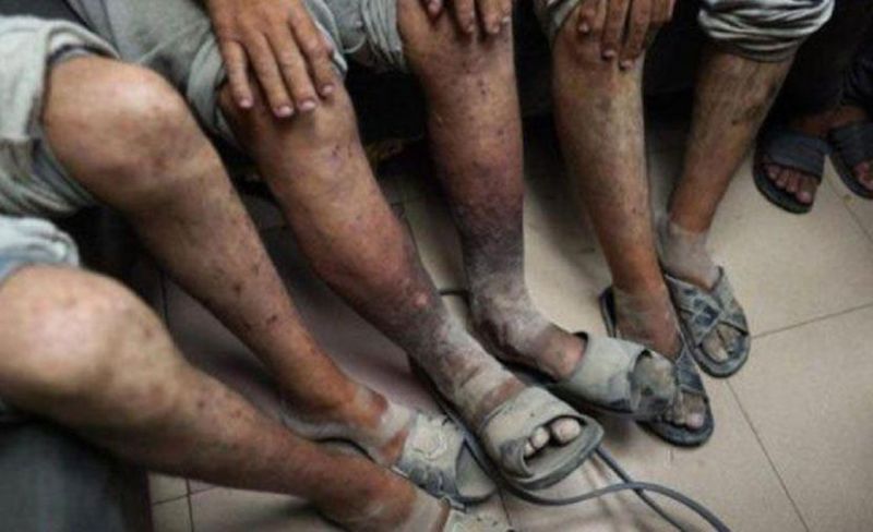 "حنظلة" يُحذر من تفشي الجرب بين الأسرى داخل سجون الاحتلال