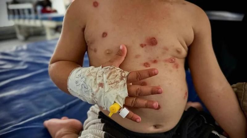 الأمم المتحدة تُحذر من تفشٍ واسع لـ "جدري الماء" يُهدد النازحين في قطاع غزة